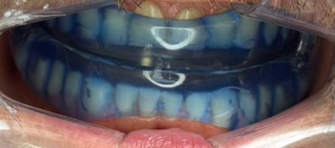 Tratamiento de Apnea